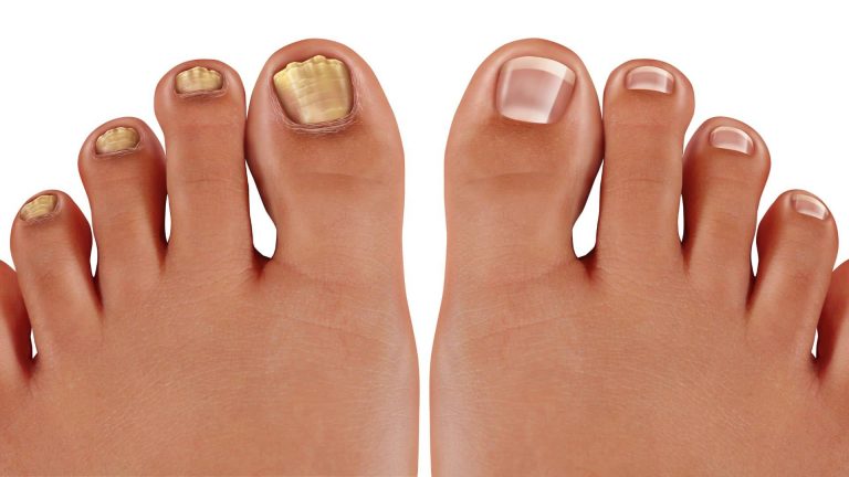 Natural Solution for Nail Fungus: The Best Alternative to Antifungal Creams and Drugs