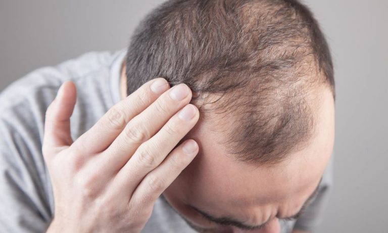 Hair Loss and DHT: 6 Effective Strategies to Combat and Regain Hair
