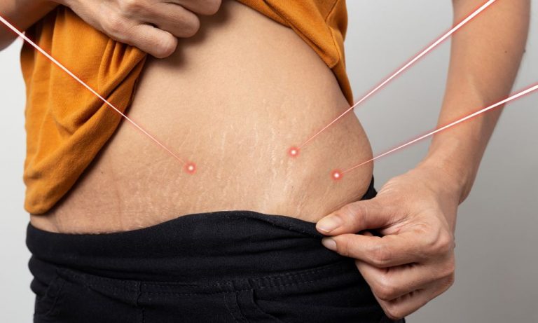 How to Get Rid of Stretch Marks: 12 Effective Methods and Natural Remedies