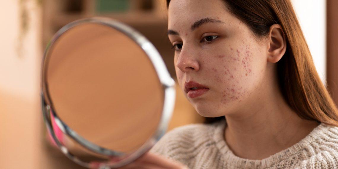 Herbal and botanical natural treatments that clear pimples gently