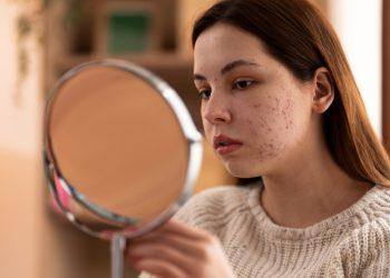 Herbal and botanical natural treatments that clear pimples gently