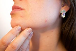 10 Natural Remedies to Banish Acne for Good