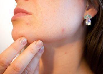 10 Natural Remedies to Banish Acne for Good