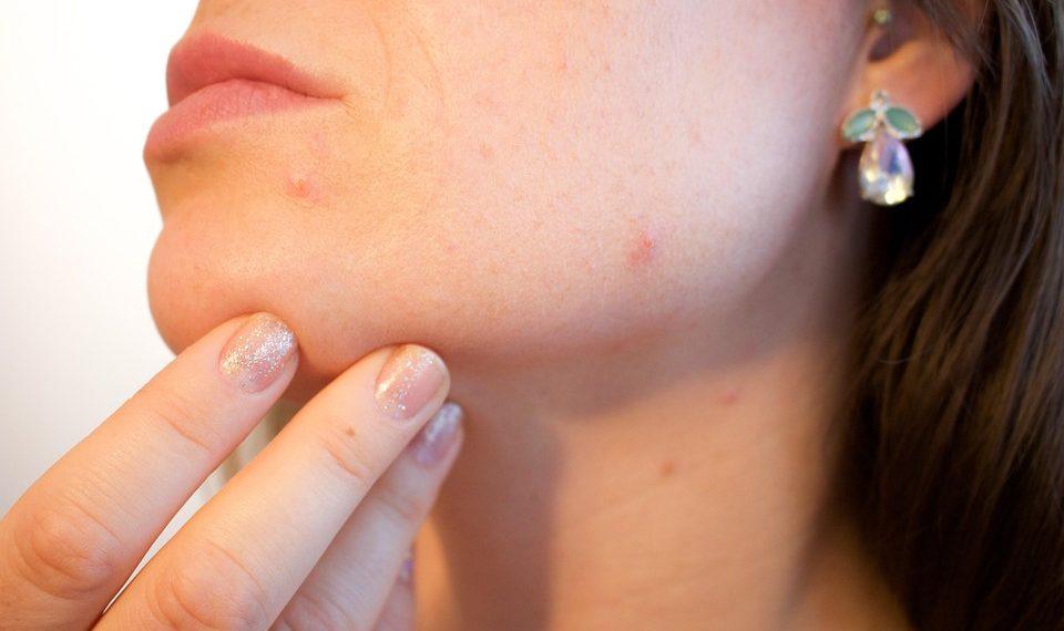 10 Natural Remedies to Banish Acne for Good
