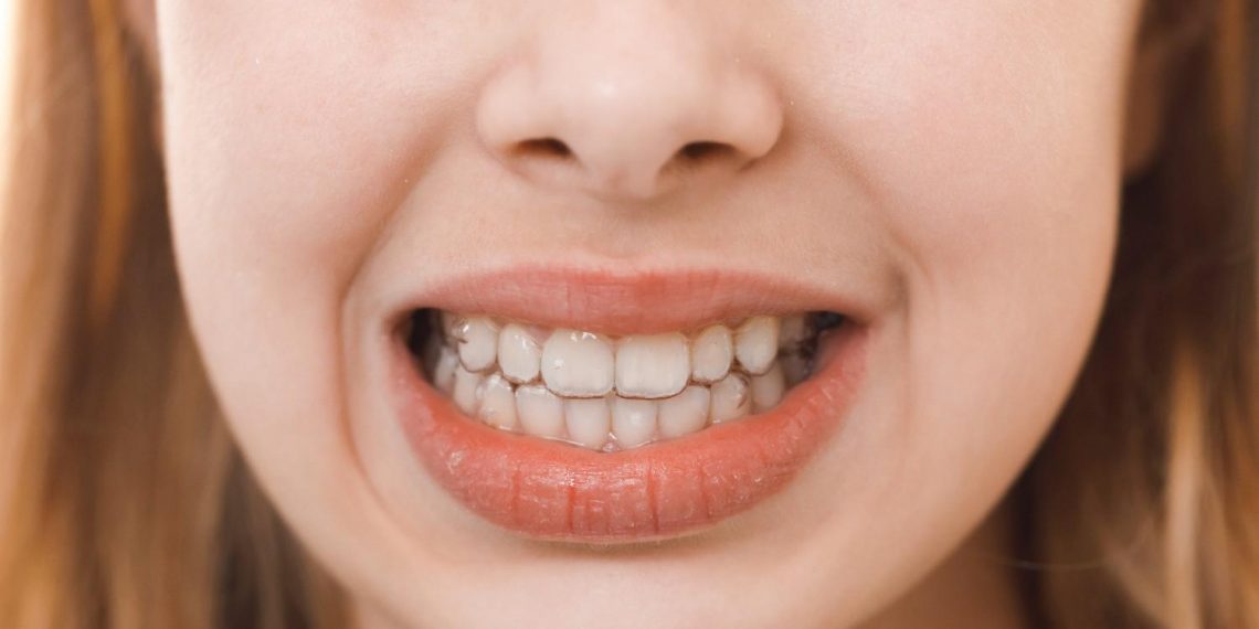 {focus_keyword} clear aligners on smiling child's teeth