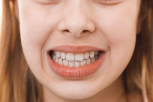 {focus_keyword} clear aligners on smiling child's teeth
