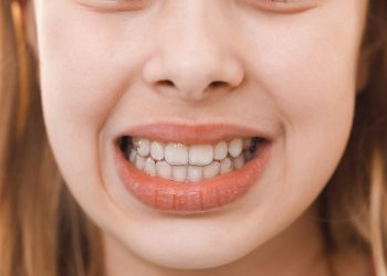{focus_keyword} clear aligners on smiling child's teeth