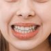{focus_keyword} clear aligners on smiling child's teeth