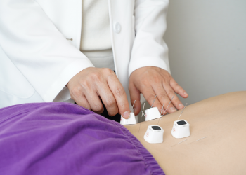 Acupuncture session with needles on patient’s back and practitioner adjusting them.