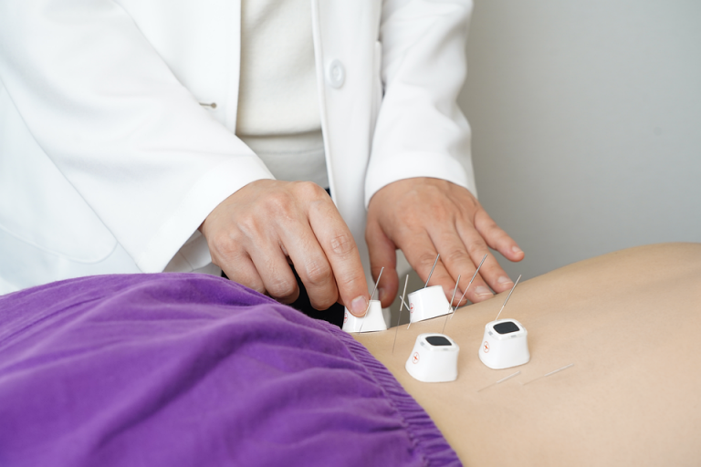 Acupuncture session with needles on patient’s back and practitioner adjusting them.