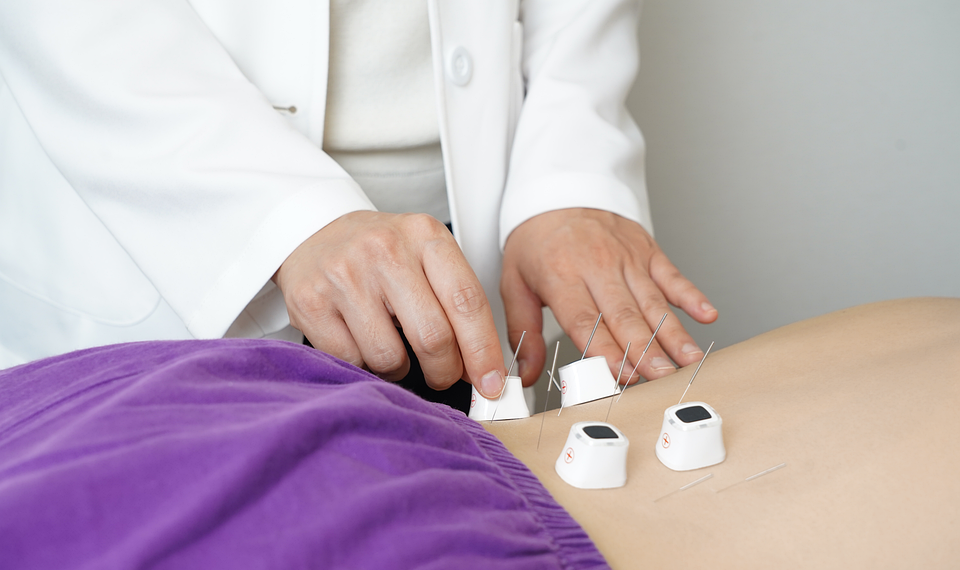 Acupuncture session with needles on patient’s back and practitioner adjusting them.