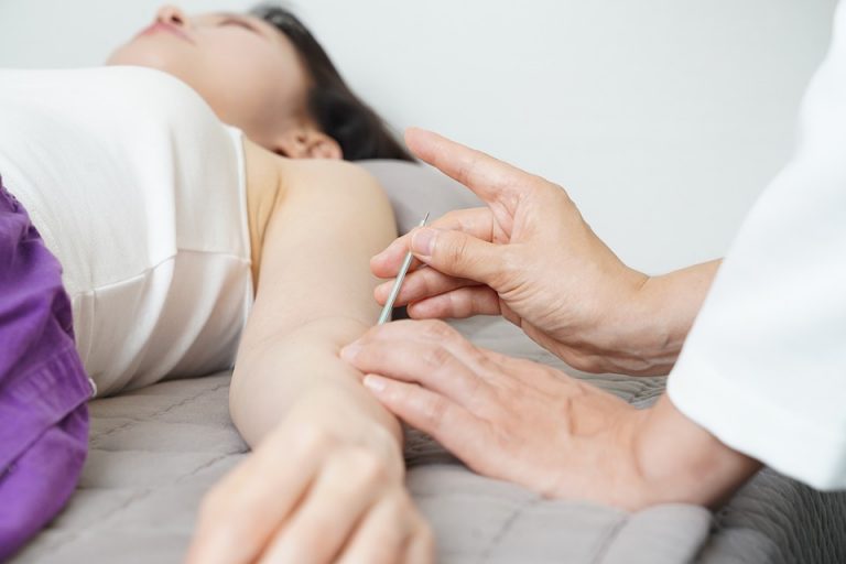 Acupuncture session with needles gently placed on a woman's arm.